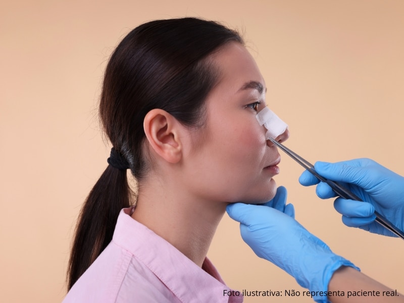 rinoplastia evolução mês a mês e adaptação
