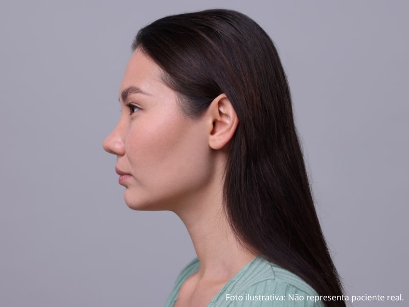 rinoplastia evolução mês a mês e resultados