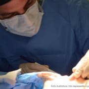 Rinoplastia para Afinar o Nariz