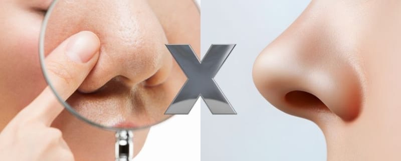 alectomia X rinoplastia estruturada