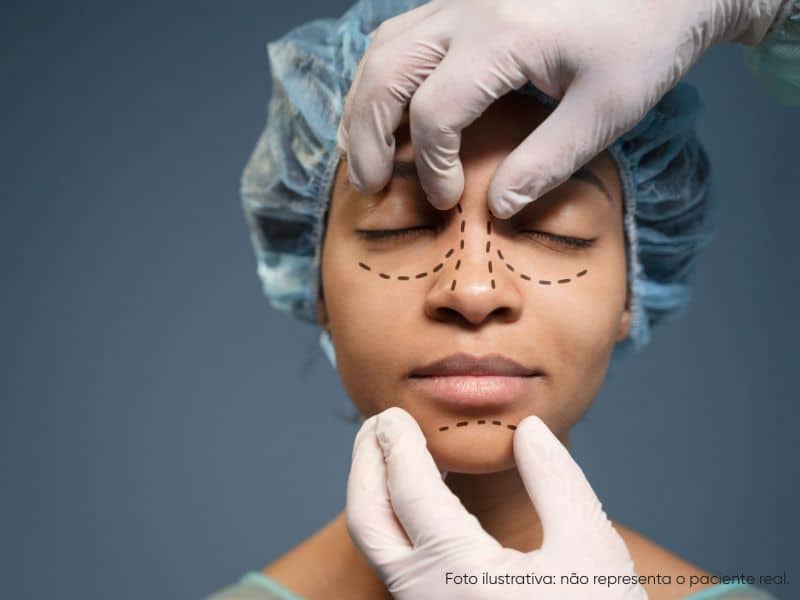 alectomia X rinoplastia estruturada quais as diferenças