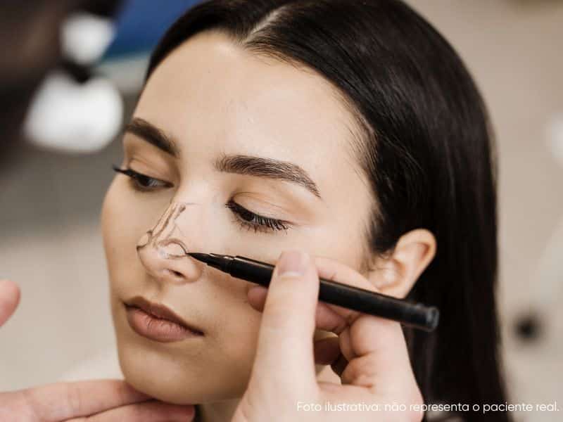 cirurgia plástica diminuir aba do nariz e quando é indicada