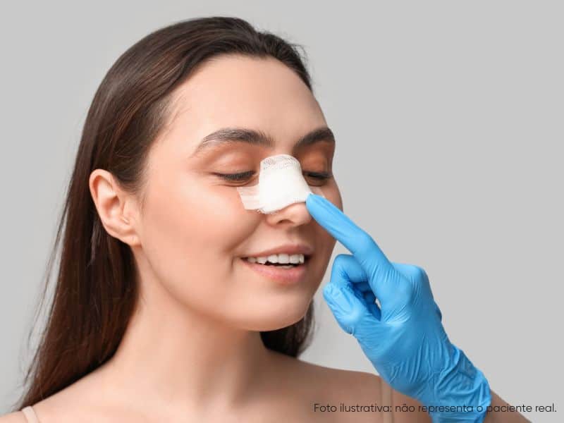 cirurgia plástica diminuir aba do nariz é segura