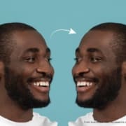 rinoplastia nariz negroide​