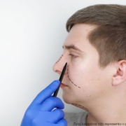 com quantos anos pode fazer rinoplastia masculina