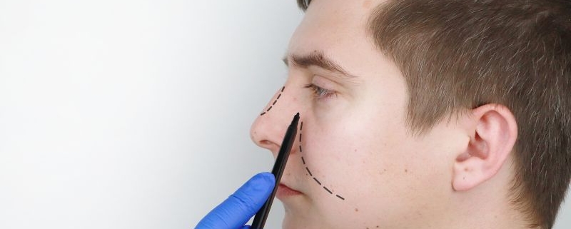com quantos anos pode fazer rinoplastia masculina
