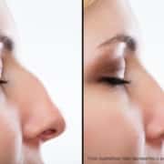 rinoplastia antes e depois