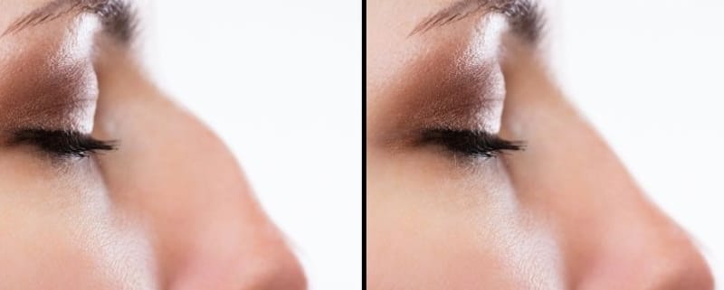 rinoplastia antes e depois