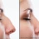 rinoplastia antes e depois
