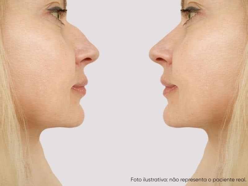 rinoplastia antes e depois como funciona