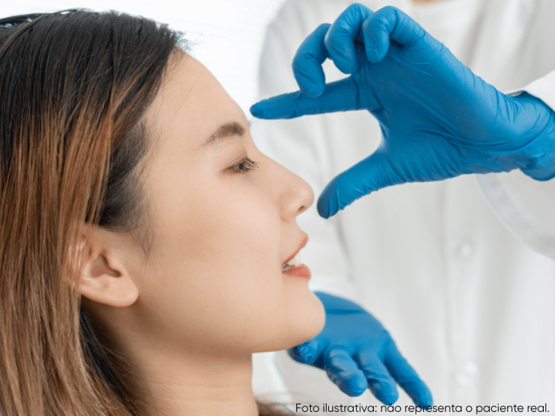 com quantos anos pode fazer rinoplastia feminina sem medo