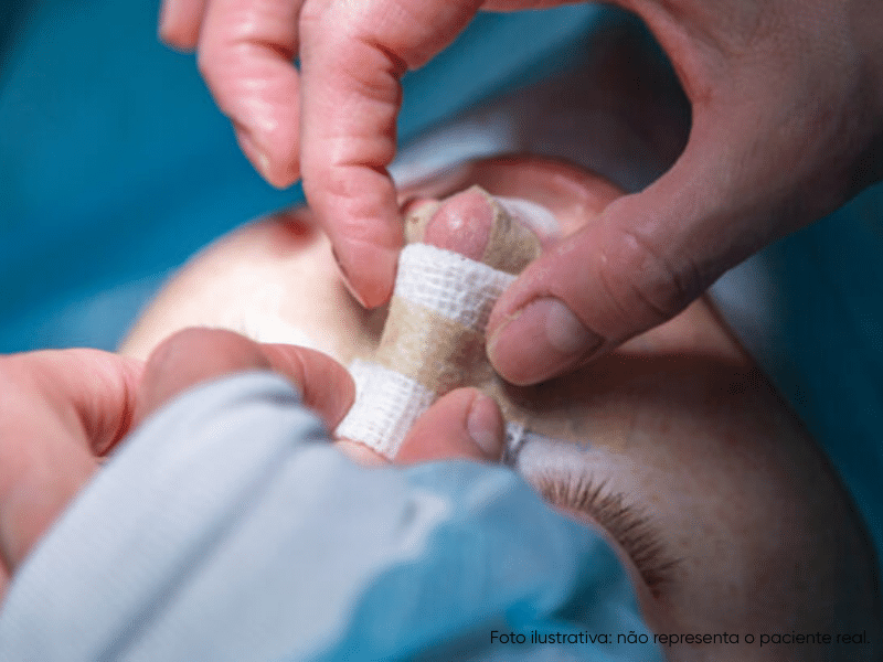 como dormir após rinoplastia primária