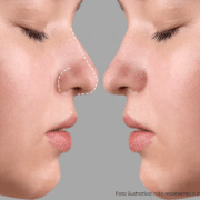 qual a diferença entre rinomodelação e rinoplastia