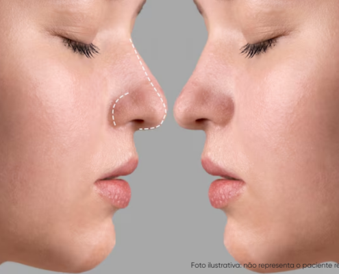 qual a diferença entre rinomodelação e rinoplastia