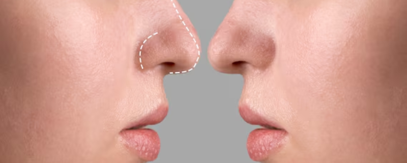 qual a diferença entre rinomodelação e rinoplastia