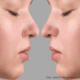 qual a diferença entre rinomodelação e rinoplastia