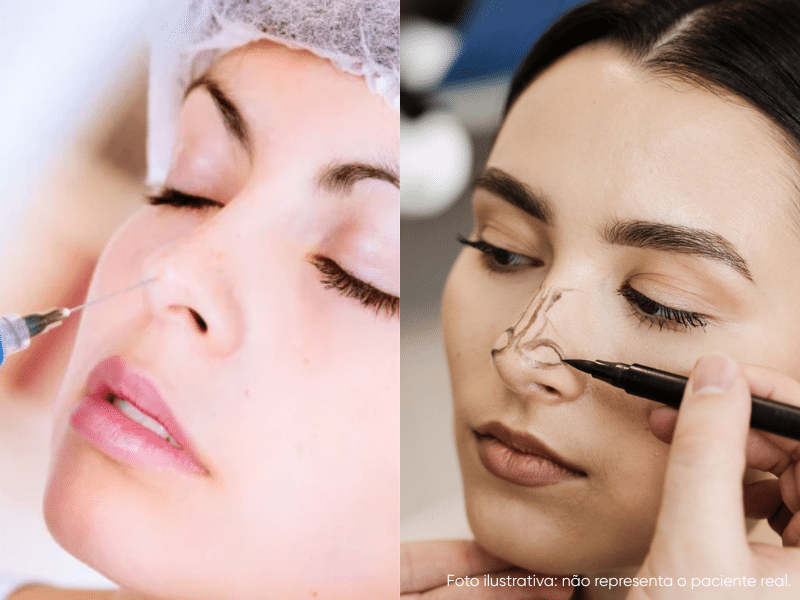 qual a diferença entre rinomodelação e rinoplastia e como saber