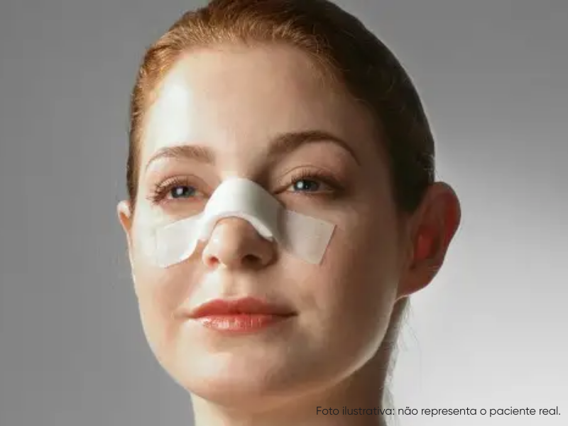 cheiro ruim após rinoplastia e quais os cuidados