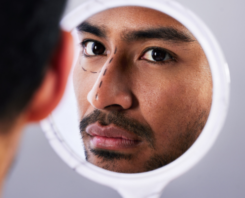 rinoplastia pele grossa antes e depois