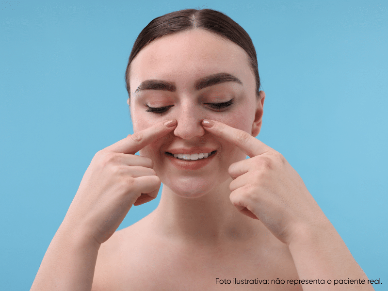 rinoplastia pele grossa antes e depois do procedimento