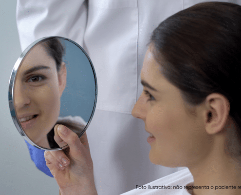 rinoplastia ultrassônica recuperação