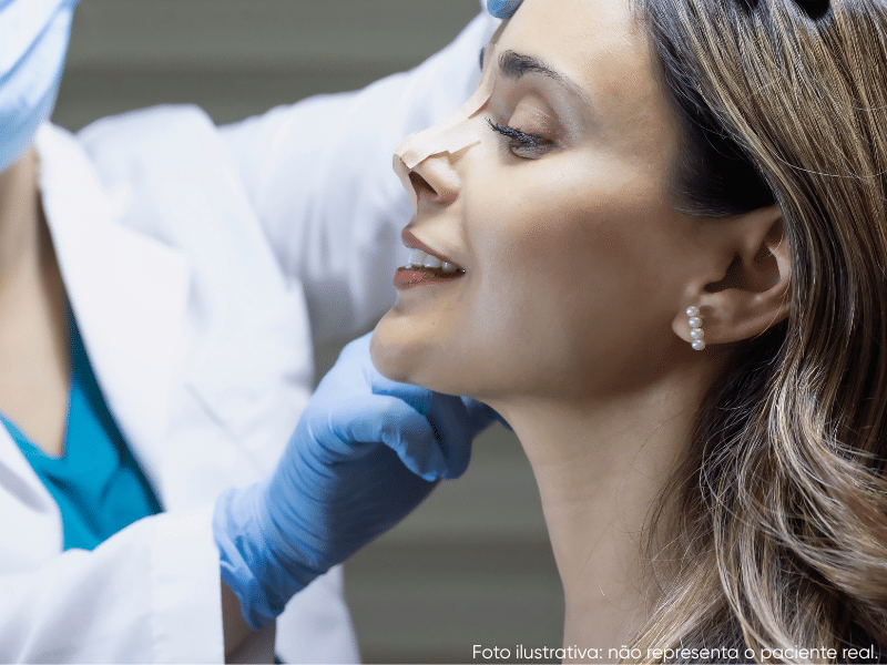 rinoplastia ultrassônica recuperação e cuidados