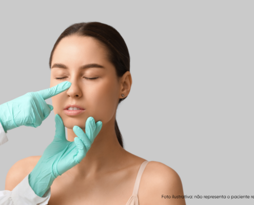 calo ósseo após rinoplastia