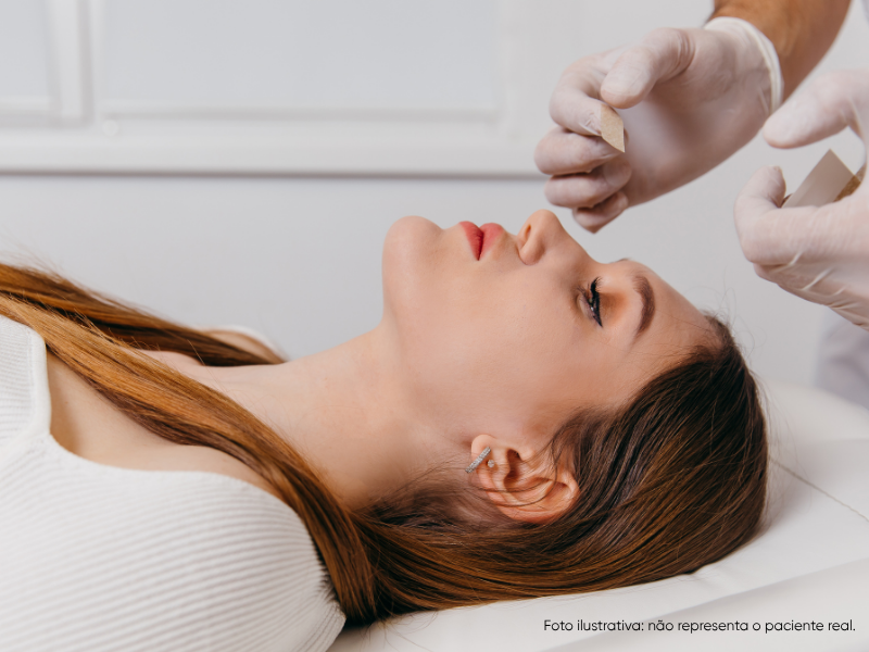 calo ósseo após rinoplastia o que é