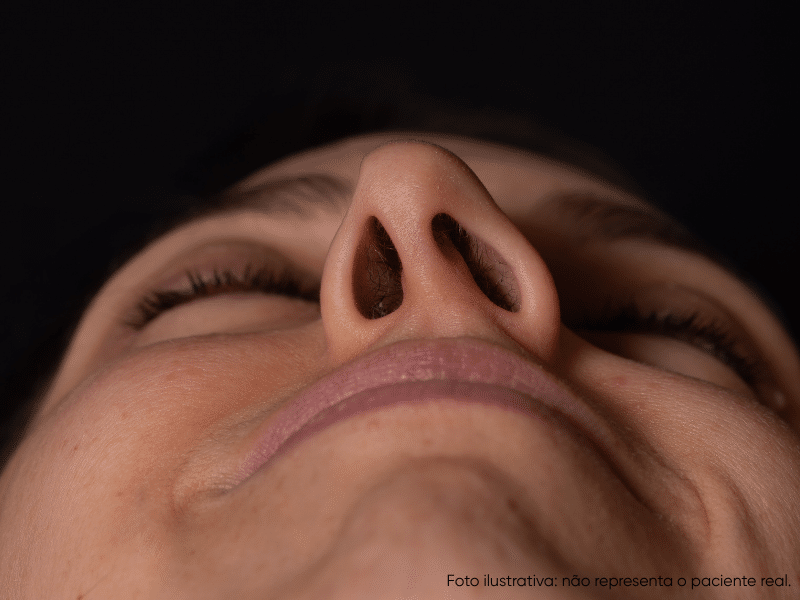 o que é desvio de septo e quais os sintomas