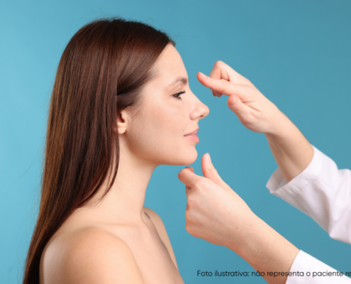 rinoplastia perfeitas