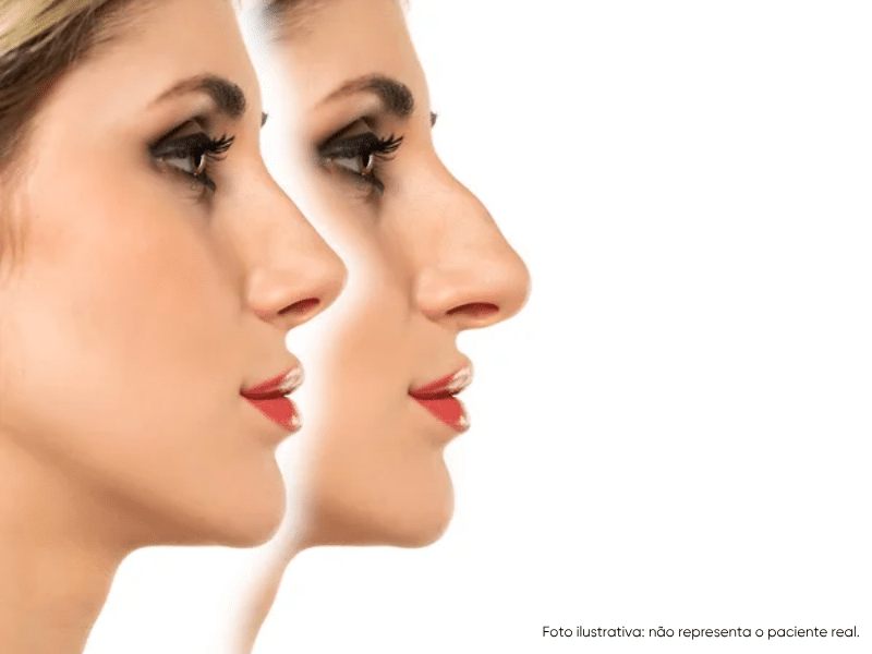 como corrigir nariz torto com rinoplastia