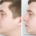 nariz torto antes e depois