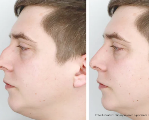 nariz torto antes e depois