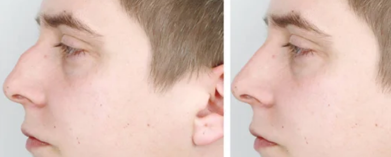 nariz torto antes e depois