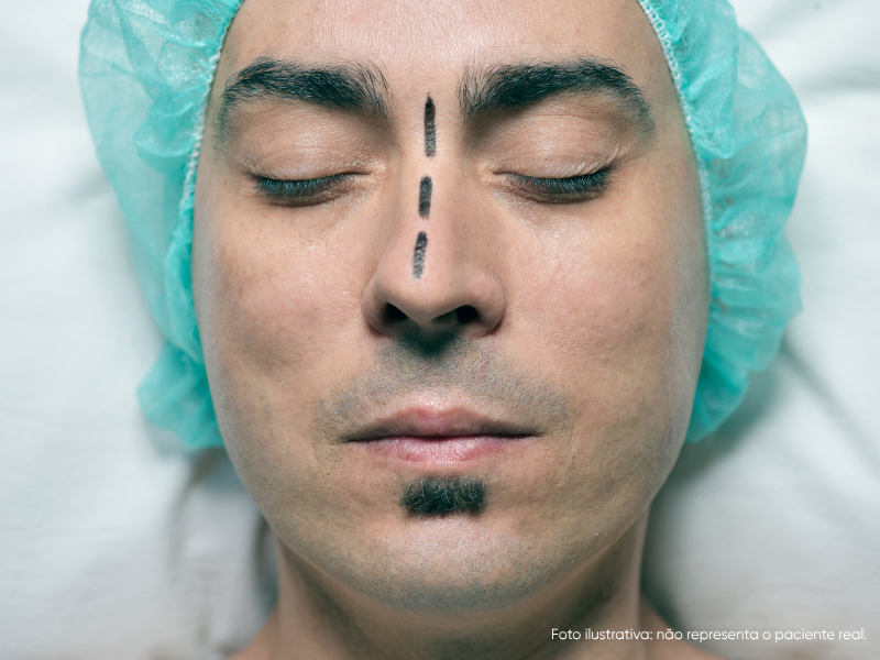 nariz torto antes e depois da rinoplastia