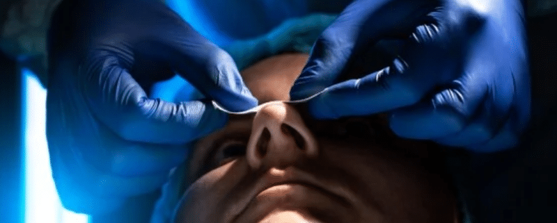 quanto custa uma cirurgia de desvio de septo