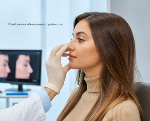 Rinoplastia fechada